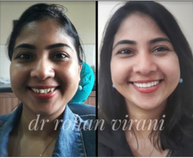 Full Mouth Rehabilitation Swiss Basal